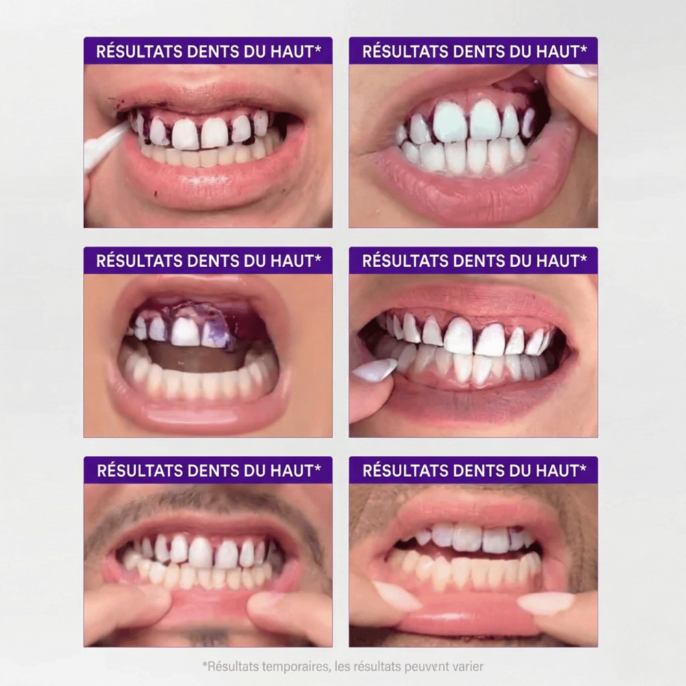 Bandes Blanchissantes Correctrices de Couleur - Smilekit™